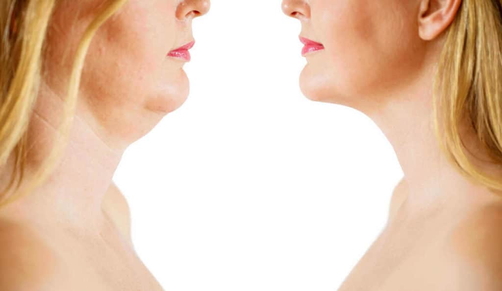 Double Chin treatment Greater London (Waltham Forest) before and after results