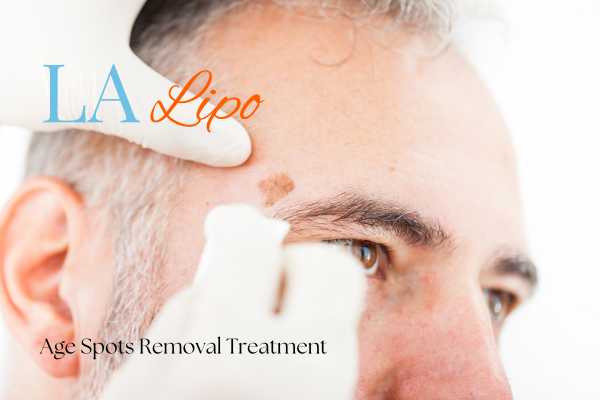 What Are the Most Effective Treatments for Age Spots Greater London (Waltham Forest)?