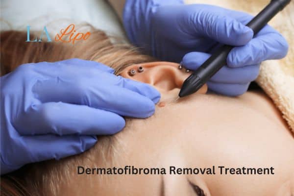 Dermatofibroma Removal Treatment Greater London (Waltham Forest)
