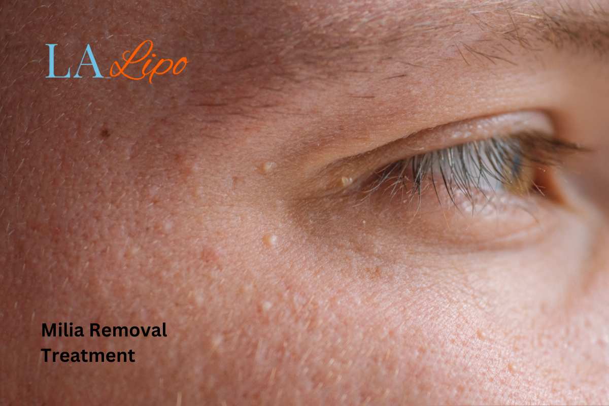 Cryopen Milia Removal: Is It the Easiest and Safest Option Greater London (Waltham Forest)?