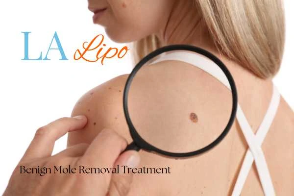 Why getting moles removed Greater London (Waltham Forest) can boost your confidence!