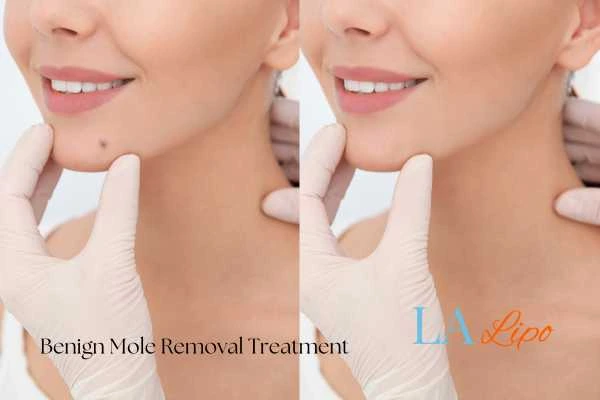 Woman's before and after results of being moles removal treatment Greater London (Waltham Forest)