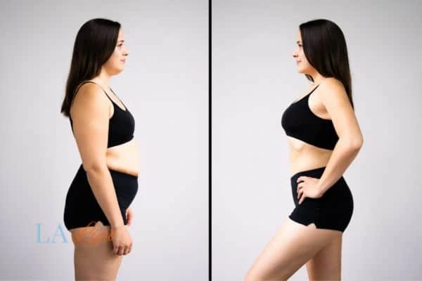 LA-EMS Body Sculpting Greater London (Waltham Forest) results before and after of womans results on body toning.