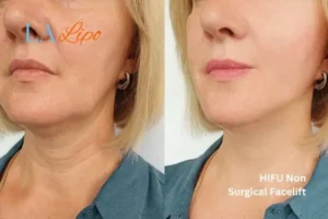 hi-fu for wrinkles Greater London (Waltham Forest) before and after results