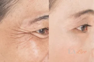 Before and after results of woman - HI-fu wrinkles reduction treatment Greater London (Waltham Forest)