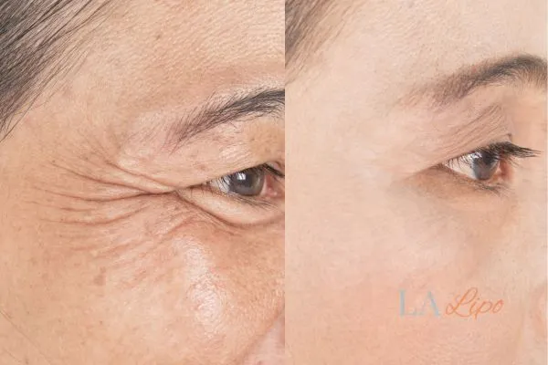 Before and after results of woman - HI-fu wrinkles reduction treatment Greater London (Waltham Forest)
