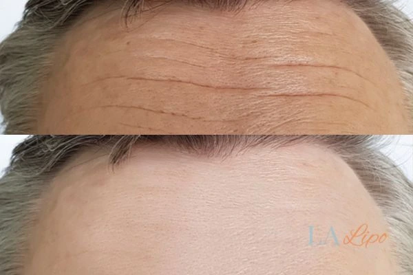 results of HIFU Greater London (Waltham Forest) on mans forehead to help reduce lines and wrinkles