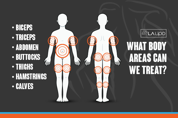 Graphic to show areas you can have LA-EMS Body Sculpting Greater London (Waltham Forest) treatment.