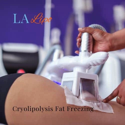 fat freezing - Cryolipolysis Greater London (Waltham Forest)