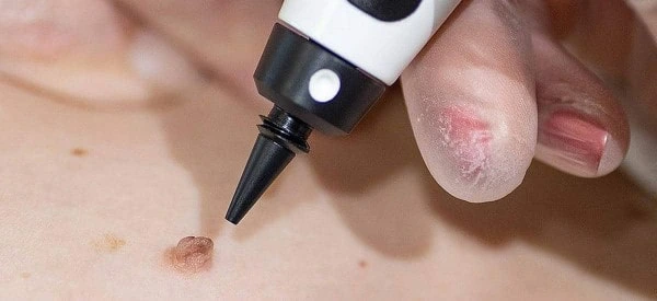 skin tag removal using cryopen Greater London (Waltham Forest)