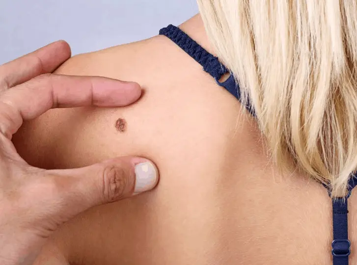 woman having mole removal Greater London (Waltham Forest) consultation before treatment.