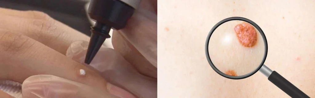 Person getting moles removed with cryopen Greater London (Waltham Forest)
