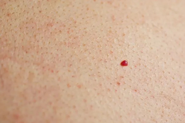 close up of a cherry angioma Greater London (Waltham Forest)