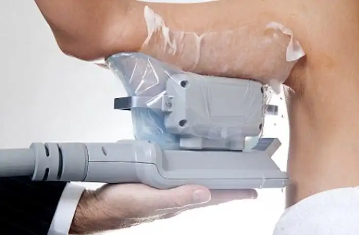 Picture of fat freezing Greater London (Waltham Forest) on the upper arms.