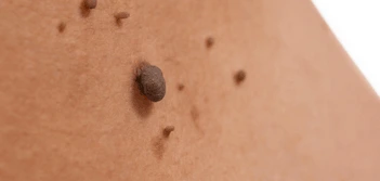 image of a skin tag Greater London (Waltham Forest)