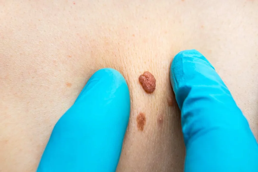 Consultant examining a skin tag Greater London (Waltham Forest)