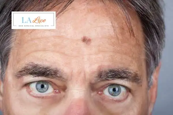 Solar Lentigo Removal Greater London (Waltham Forest) image of man with mark on his forehead