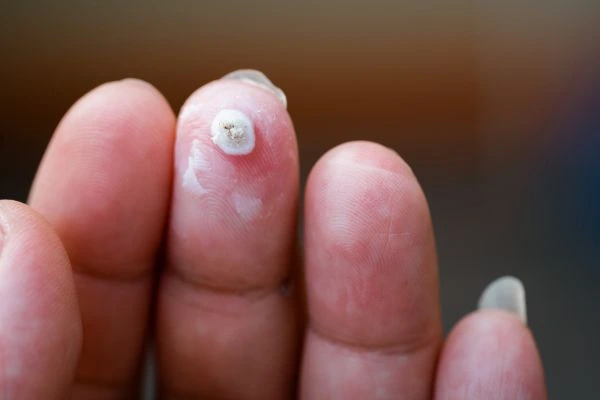 wart on person finger - cryotherapy to treat from LA LIPO Greater London (Waltham Forest)