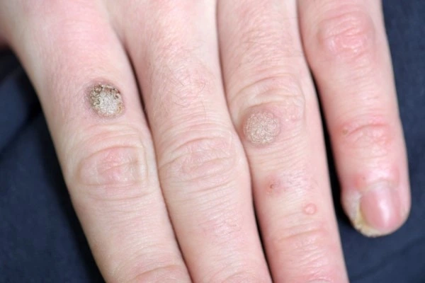 photo of warts on person hand - see wart removal Greater London (Waltham Forest) from LA LIPO