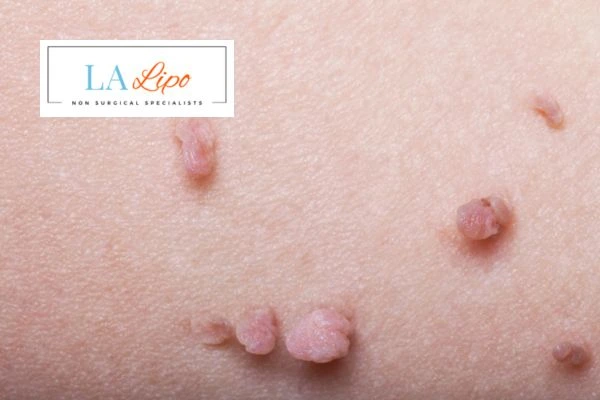 Does cryopen skin tag removal Greater London (Waltham Forest) hurt? Find out now call our team today!