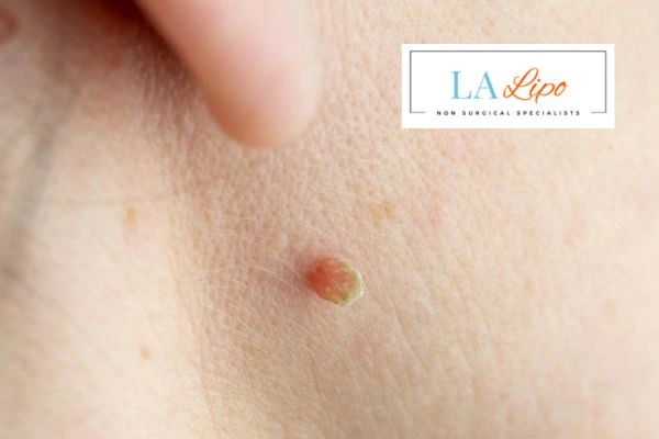 Book skin tag removal Greater London (Waltham Forest) today speak to our team now!
