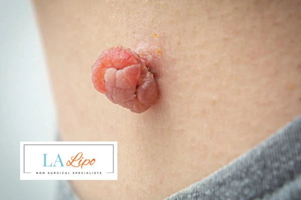 Interested in skin tag removal Greater London (Waltham Forest)? Concerned about the pain? Find out more today!