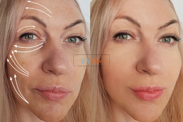 Morpheus 8 results Greater London (Waltham Forest) face lift.