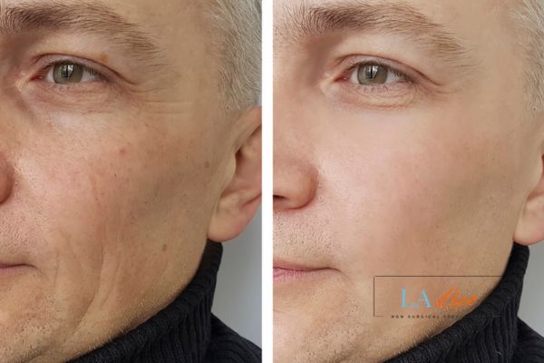 See the amazing results of Morpheus8 Treatment Greater London (Waltham Forest)!