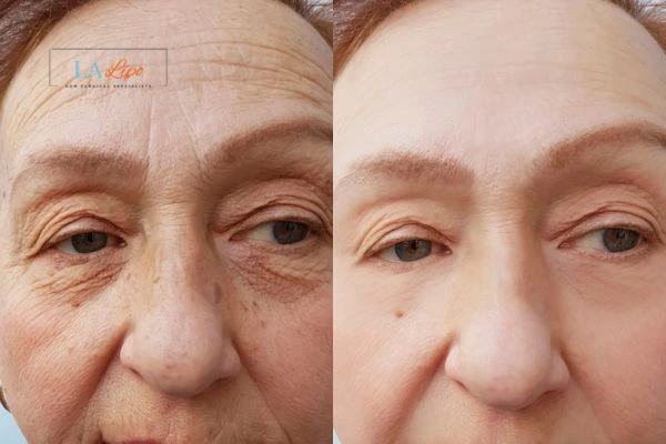 The powerful benefits of Morpheus8 Treatment Greater London (Waltham Forest) - Call Our team today!
