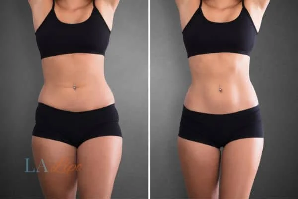 before and after results of non-surgical treatment to help a woman's body image and mental health Greater London (Waltham Forest)