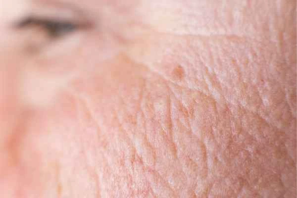 close up picture of a woman's face showing an age spot Greater London (Waltham Forest)