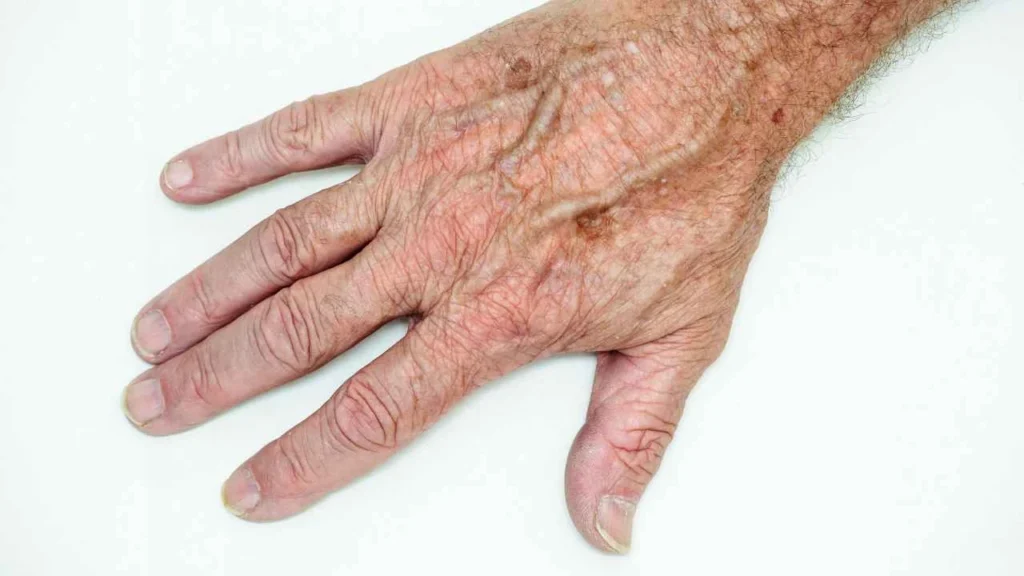 Male hand showing age spot Greater London (Waltham Forest)