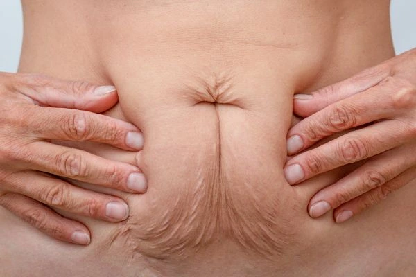 Image of a woman's stomach with loose skin - example of skin tightening Greater London (Waltham Forest) options
